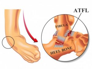 ATFL Injury - Ankle Sprain | Dr. Sai Krishna B Naidu