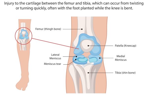 Illustration of knee anatomy and meniscus tears