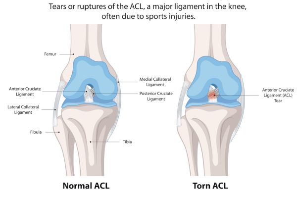 Comparison of normal and torn ACL in the knee